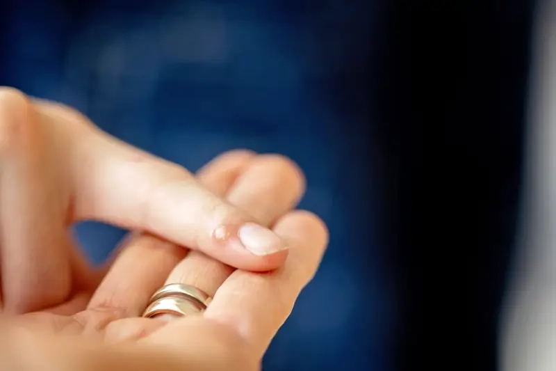 Co jest dobre na kurzajki?