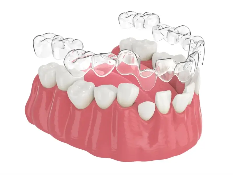 Invisalign dla kogo?